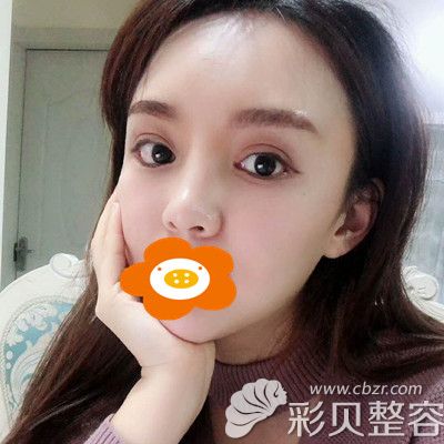 膨体垫眉弓一个月效果分享