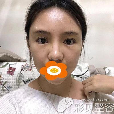 假体垫高眉弓6mm术后一周拆线