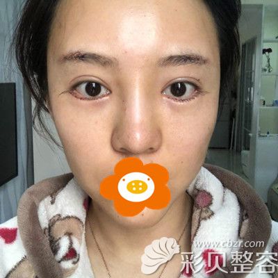 刚做完手术后拍的图片