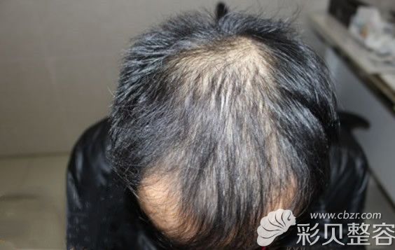植发前照片