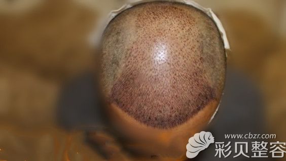 毛发移植即刻效果