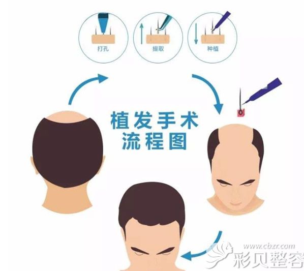合肥丛生植发过程图解