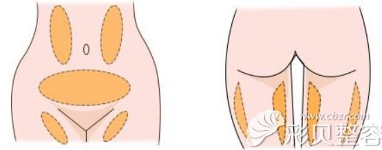 自体脂肪矫正O型腿抽取脂肪的部位
