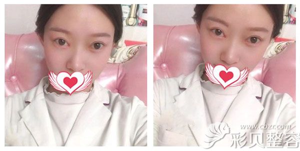 双眼皮一个月宽窄基本已经定型