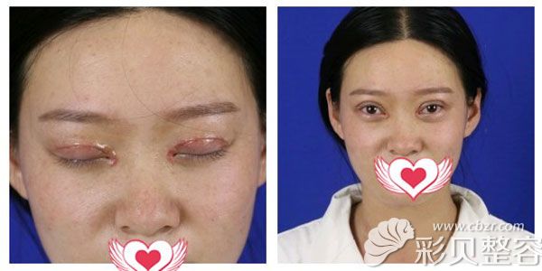 切开双眼皮第四天缝线流畅