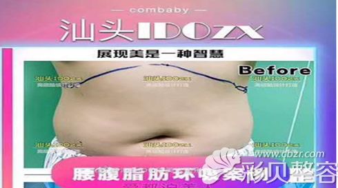 腰腹环形吸脂前