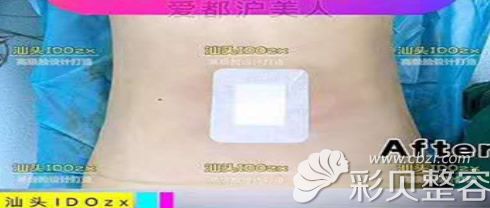 腰腹环吸6个月效果图