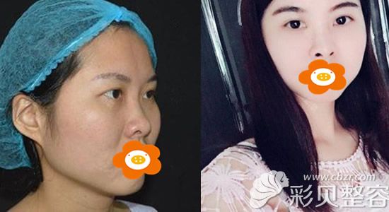 意大利悦升线做脸部埋线效果图