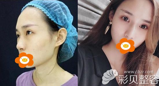 全脸埋线提升术后一个月照片