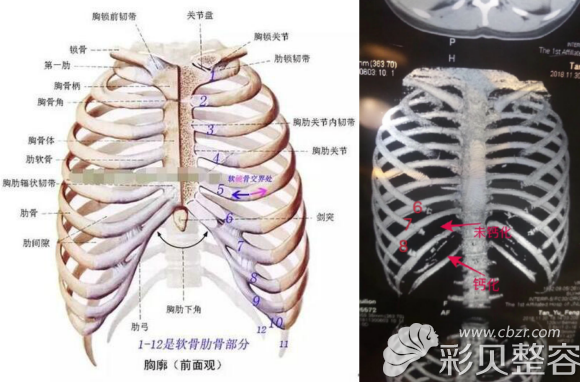 肋骨鼻需要拍肋骨ct 肋骨鼻需要拍肋骨ct