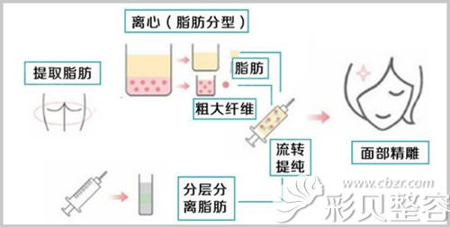 自体脂肪面部填充过程图解