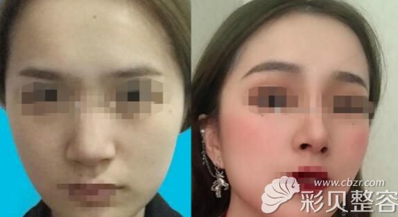 真实案例:自体肋骨鼻半年后效果 真实案例:自体肋骨鼻半年后效果