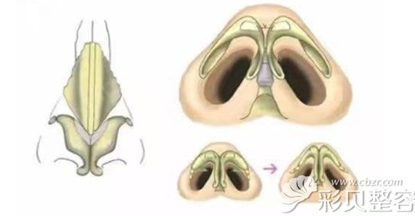 在韩国做鼻头软骨支架取出,鼻子出现挛缩塌陷的几率大吗？