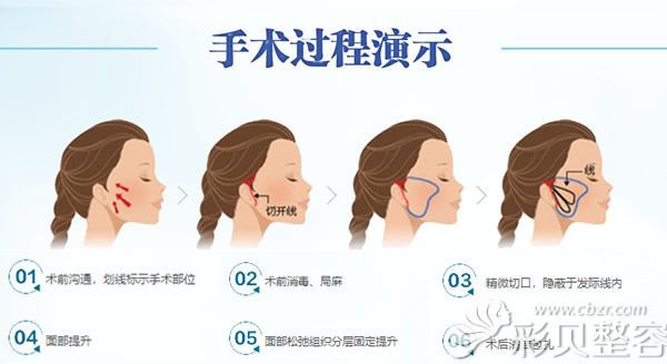 微拉美手术原理和过程