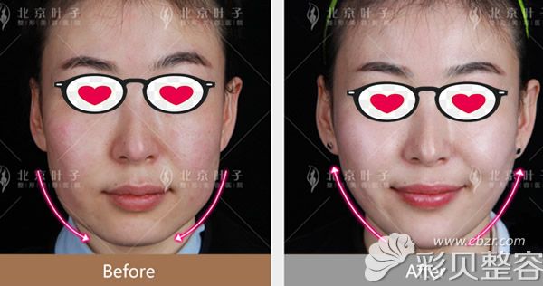 北京叶子整形真人微拉美面部提升效果案例