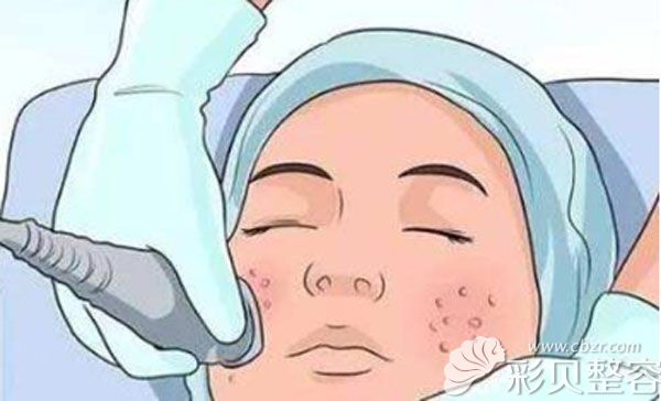 美容微针多久做一次，副作用大不大