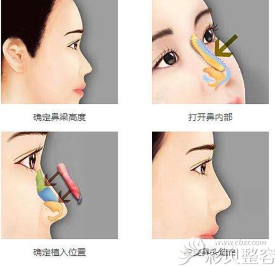假体隆鼻+耳软骨隆鼻流程