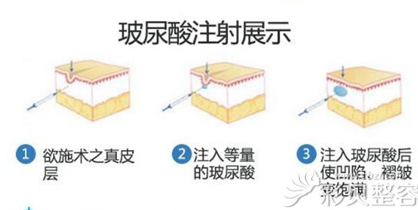 玻尿酸注射流程