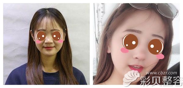 做完第五代热玛吉修复后的前后对比照