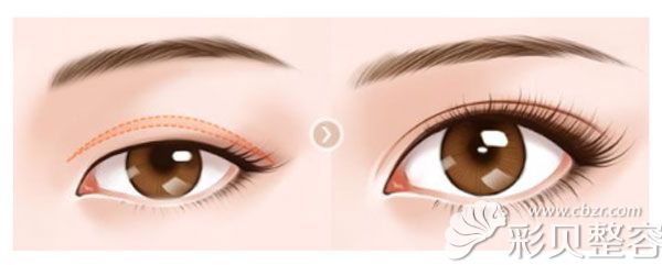 上睑提肌后眼睛吊着，一个月后消肿了会降下来一点吗