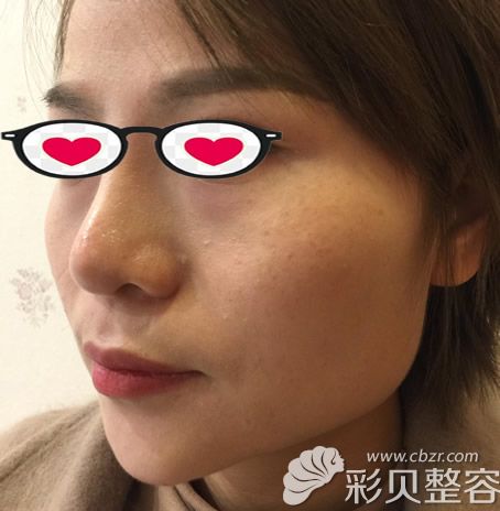 颧骨和下颌角磨骨前照片