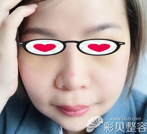 下颌角整形+颧骨整形第十天图片