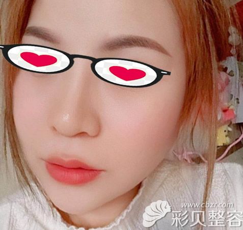 面部轮廓整形一年后效果