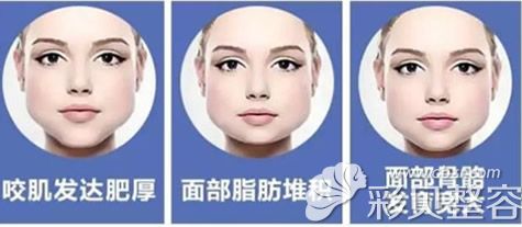 国字脸方脸形成的原因