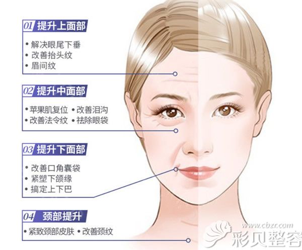 ​我大V线面部提升后脸变大变宽了,早知道就让线走头皮做了