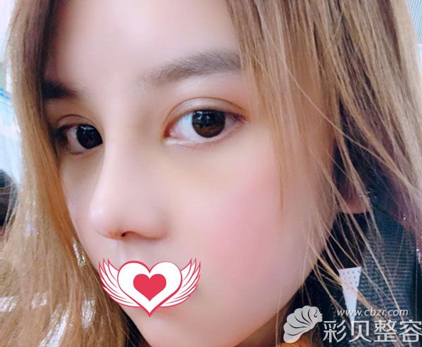 耳耳软骨隆鼻第7天拆线鼻头红