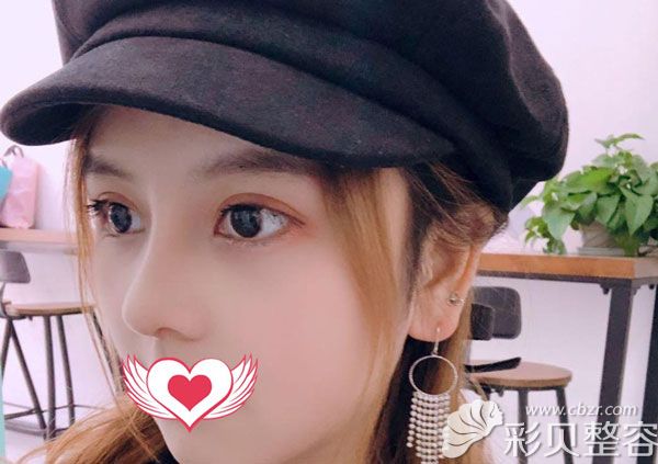 做完隆鼻手术三个月的恢复效果图