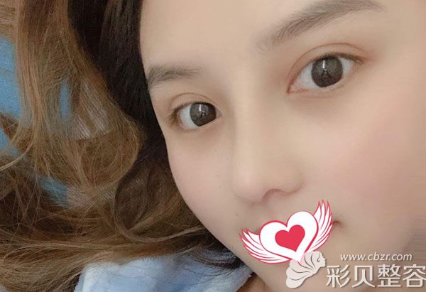 自体软骨一个月吸收的很少