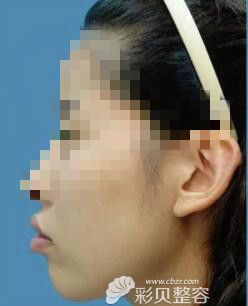 牙很齐不龅牙,但上嘴唇外凸侧脸照片