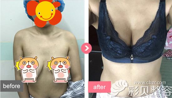 乳房上提手术效果能维持多久?分享我做人工韧带提升术经历