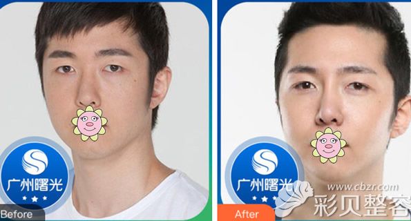 男生膨体隆鼻效果案例