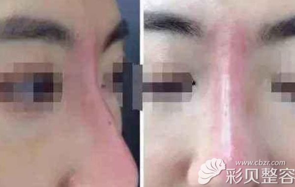 隆鼻排异早期图片