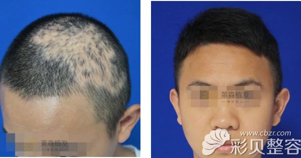 疤痕植发案例