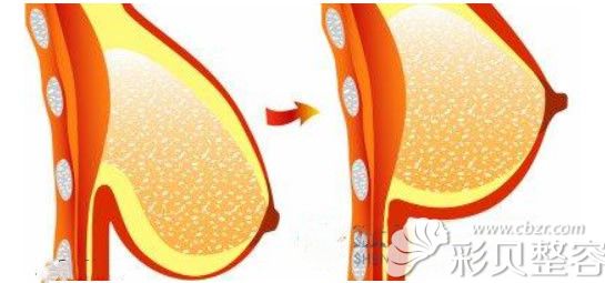 乳房重度下垂建议做棒棒糖悬吊或人工韧带提升双环法可pass