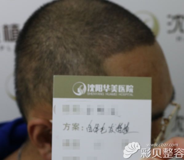 发际线种植+头顶加密四个月后