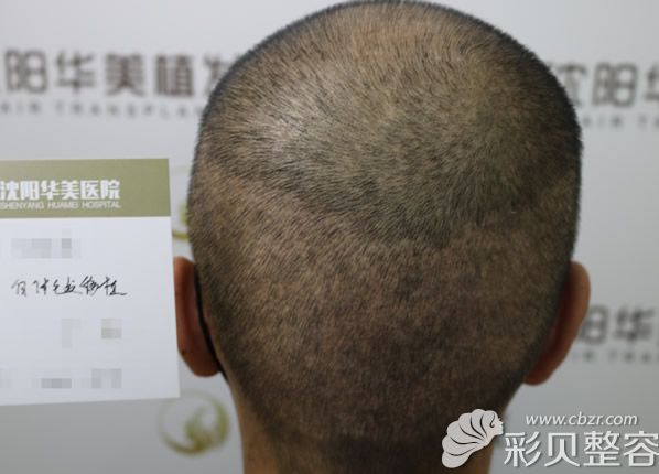 植发一年后后枕部恢复的情况