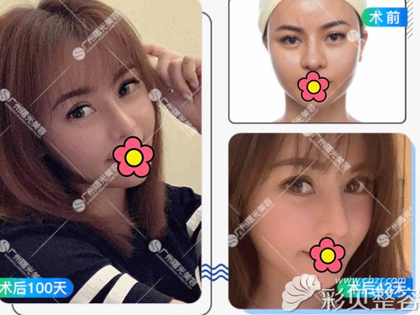 舒铂超肋骨隆鼻效果