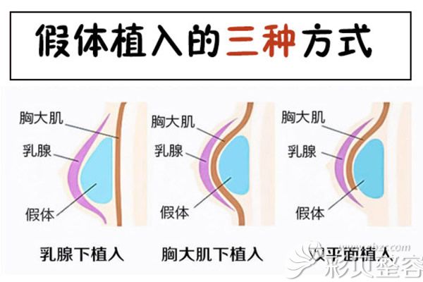 隆胸假体放置的位置