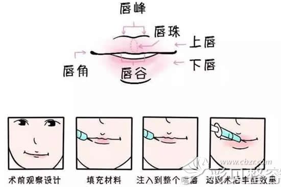 玻尿酸丰唇前后过程