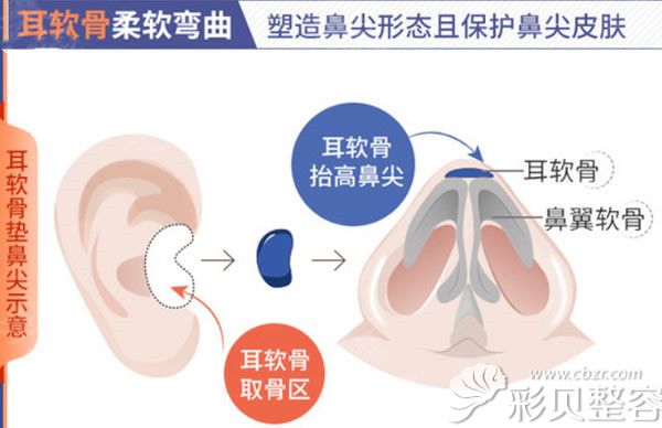 取耳软骨部位