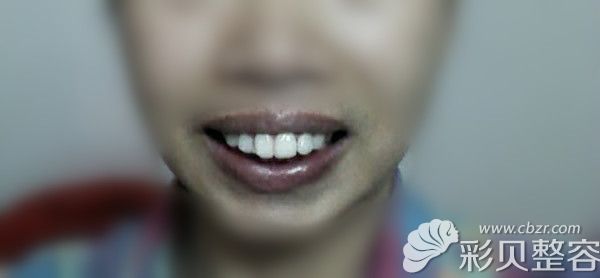 上嘴唇包不住牙龈图片