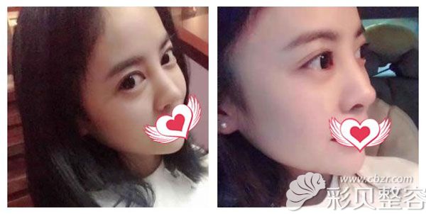 肋骨隆鼻一个月的恢复效果图