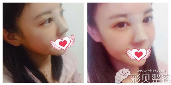 鼻修复手术第7天鼻子挺起来了