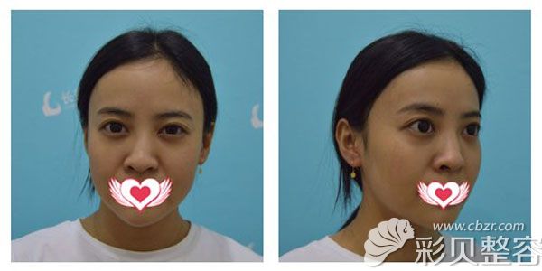 歪鼻矫正手术前