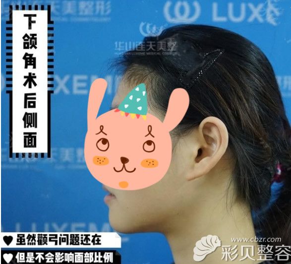 下颌角长曲线截骨术图片