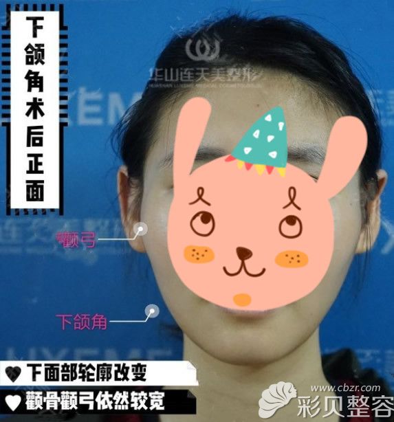 磨骨手术一年后效果图